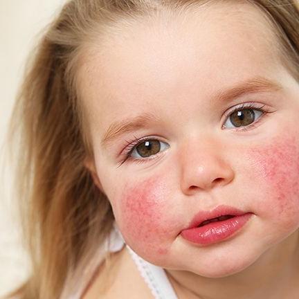 Pakiet badań - alergiczny pediatryczny (27 alergenów)