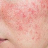 Badanie na obecność nużeńca